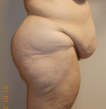 Side view Before  Body Lift