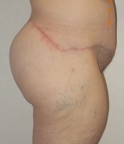 Side view After Body Lift