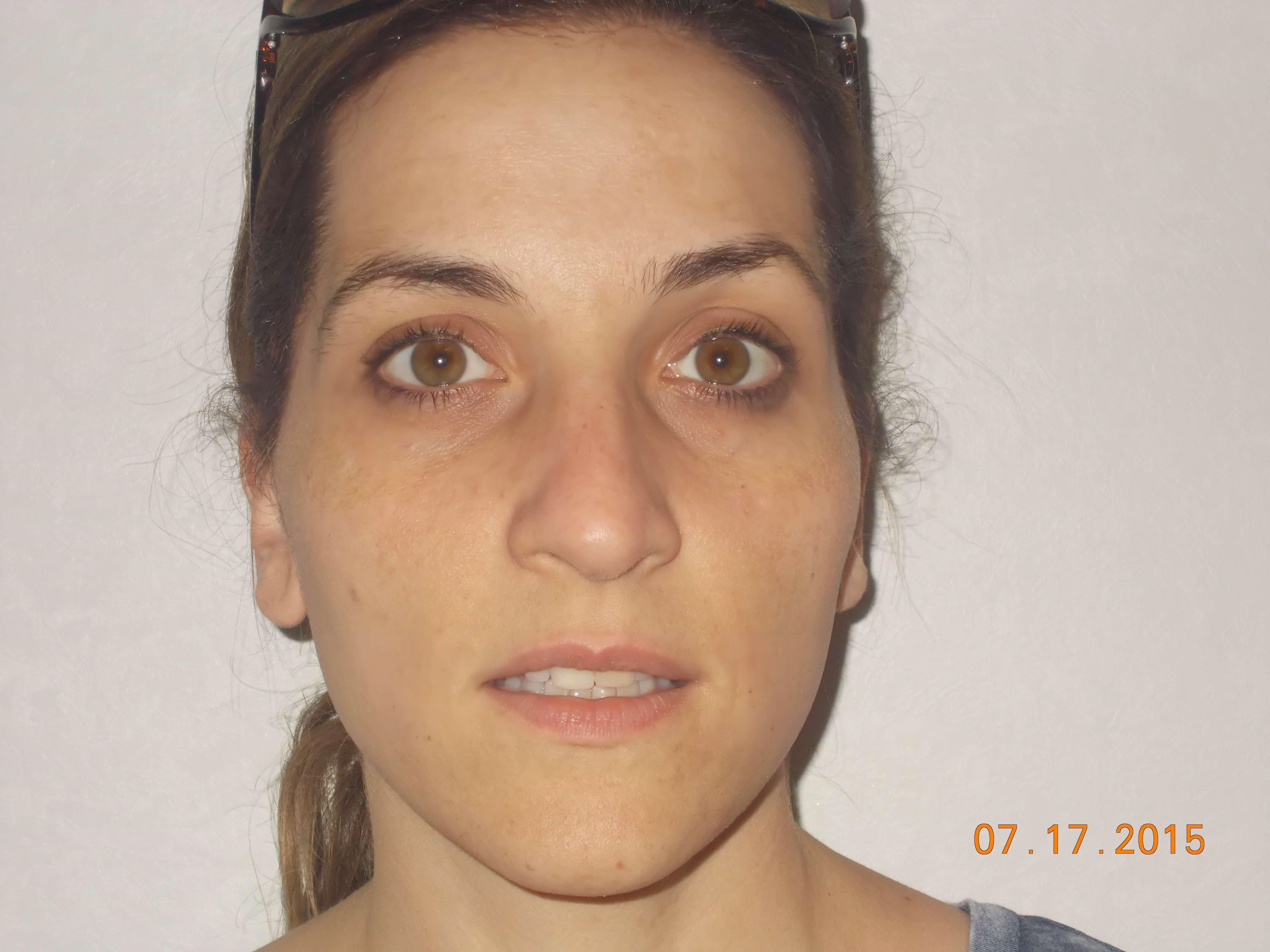 Before Image