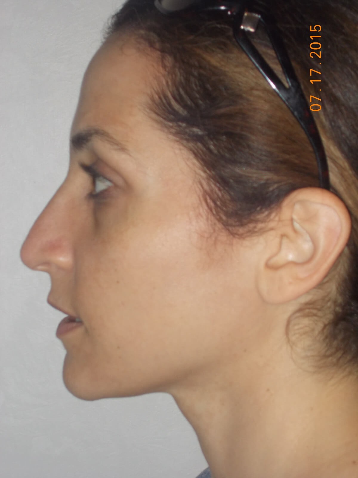 Side View Before