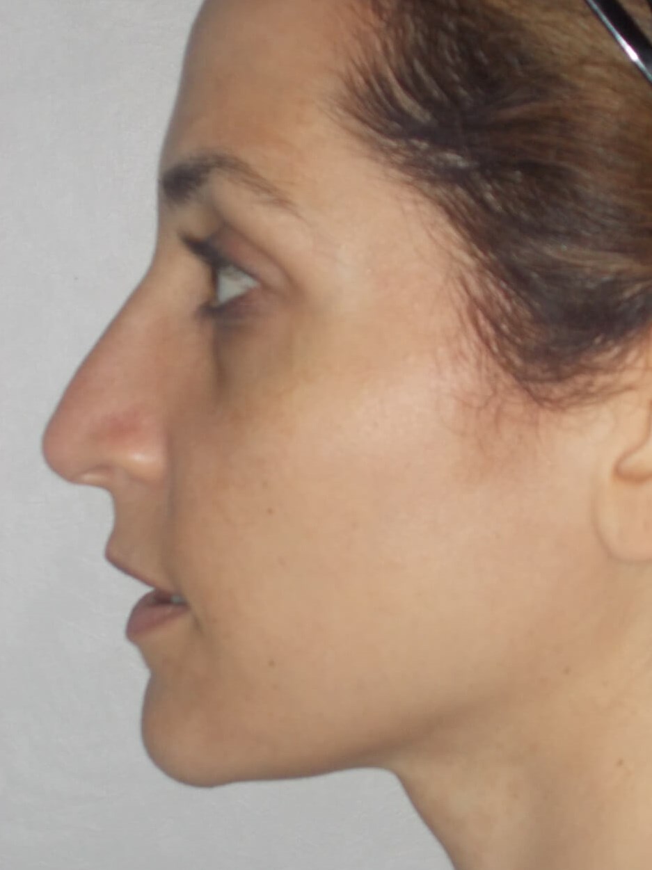 Side View Before