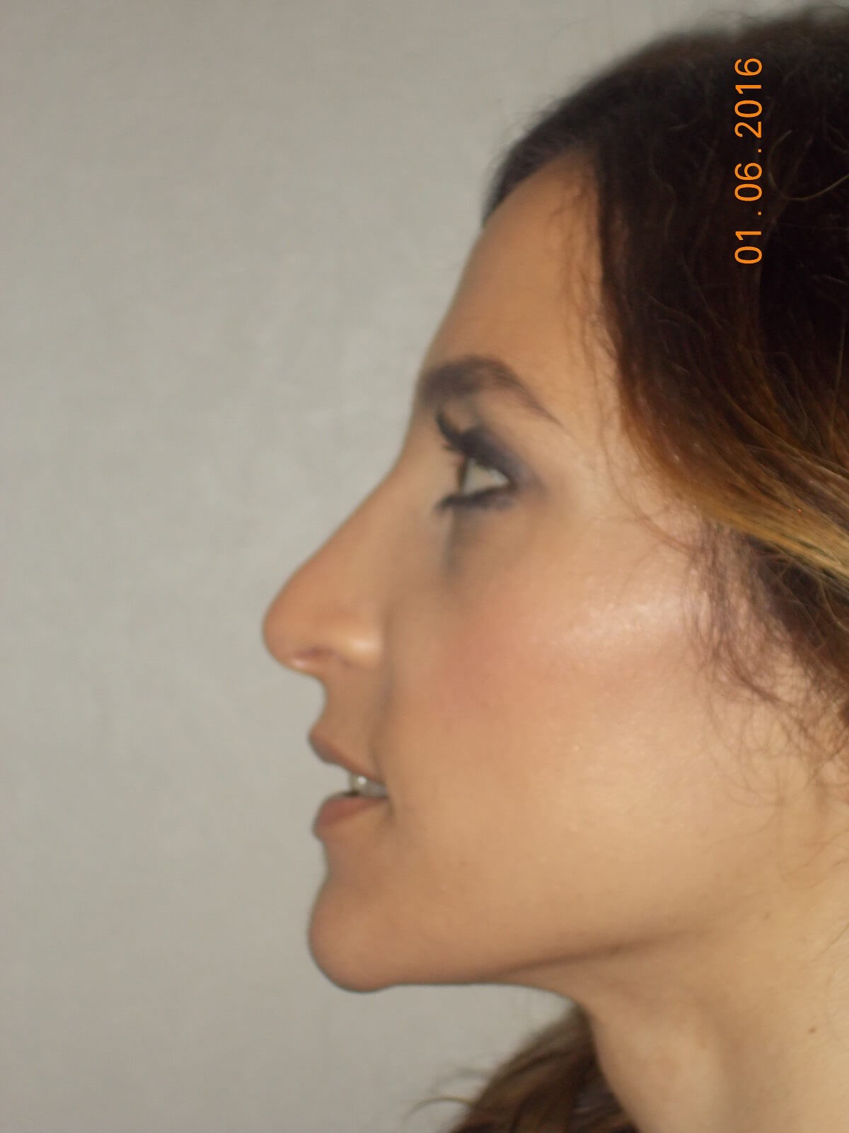 Side View After