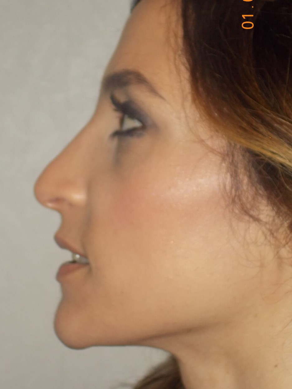 Side View After