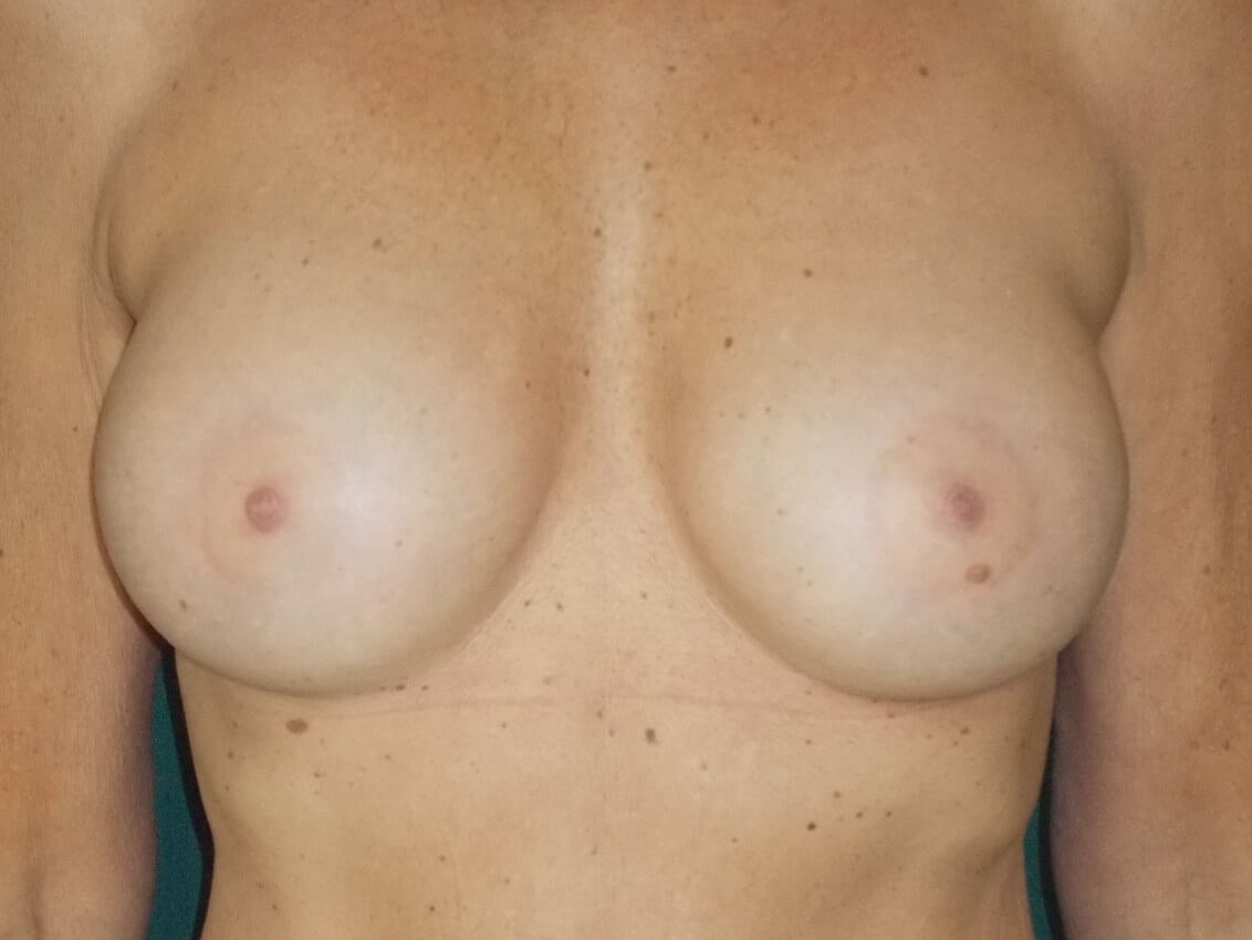 Front View After