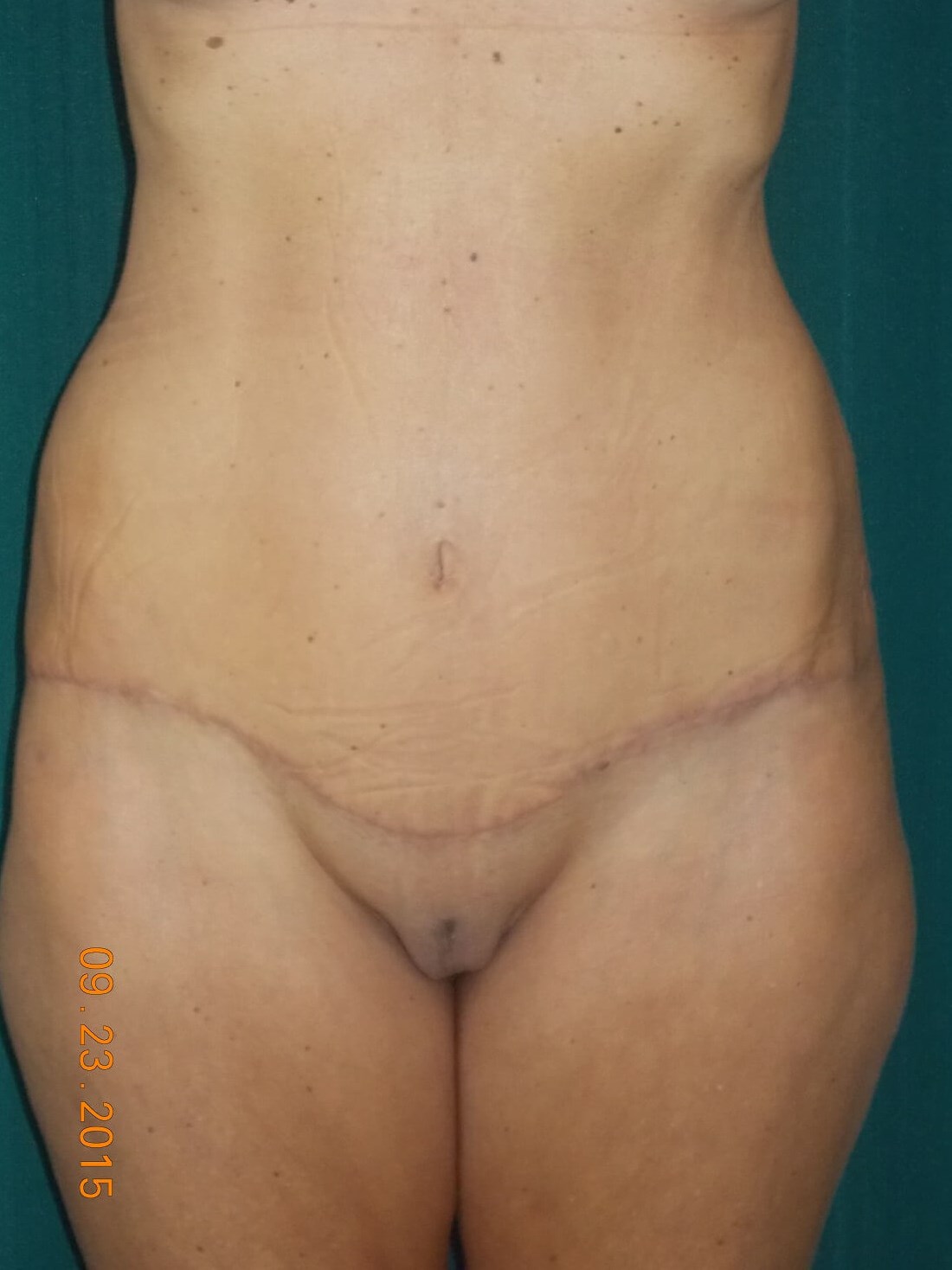 Front View After