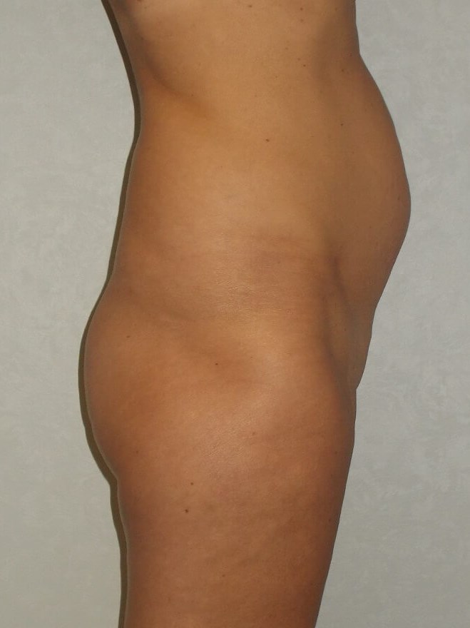 Side View Before