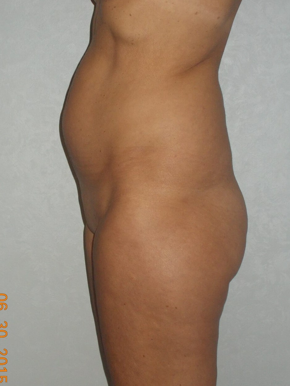 Side View Before