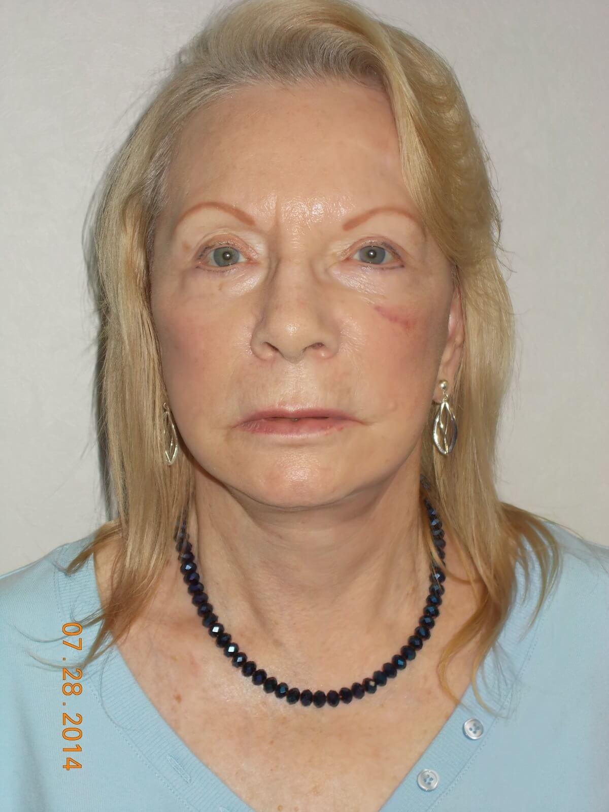 Front View After
