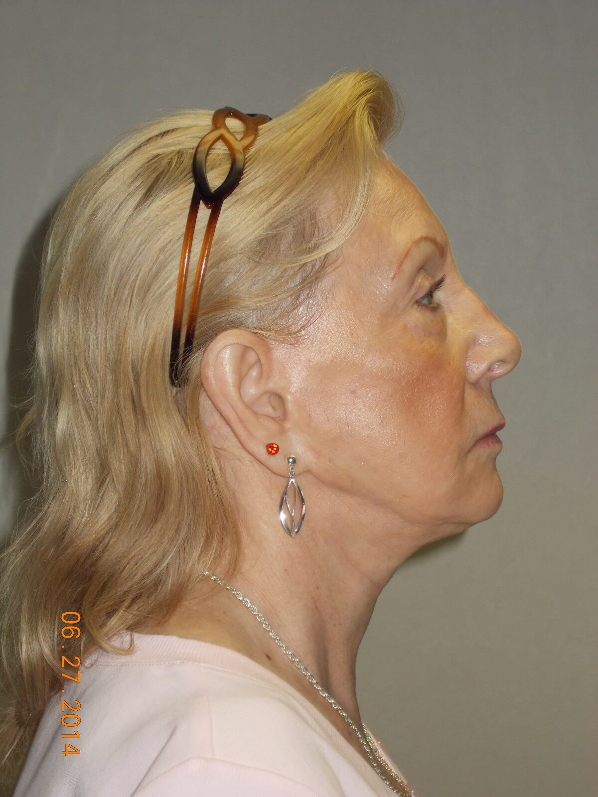 Side View Before