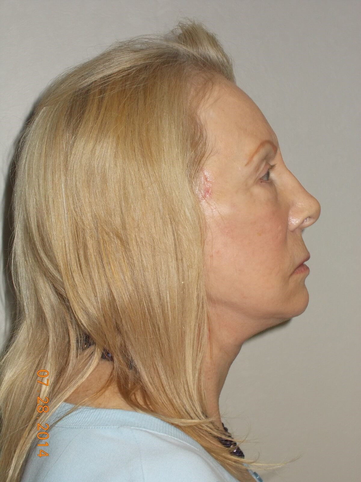 Side View After