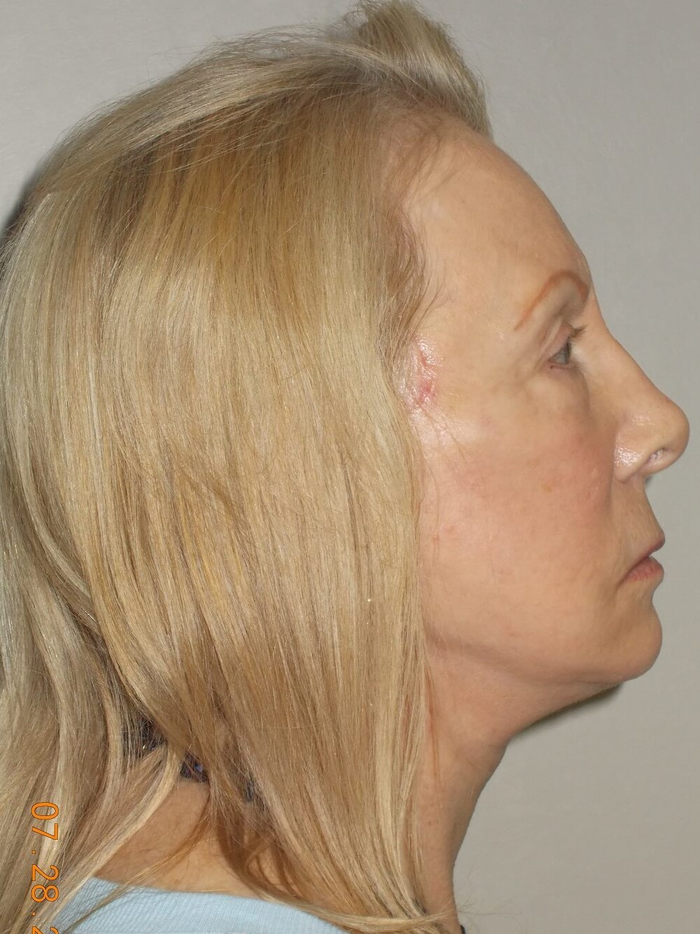 Side View After