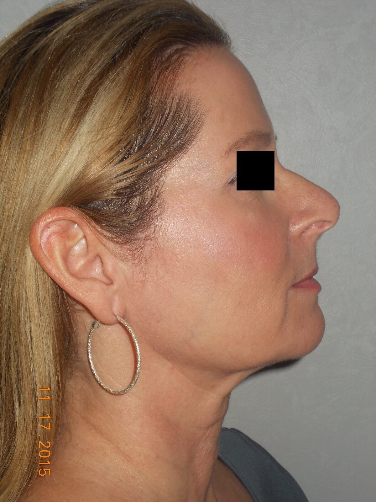 Side View Before