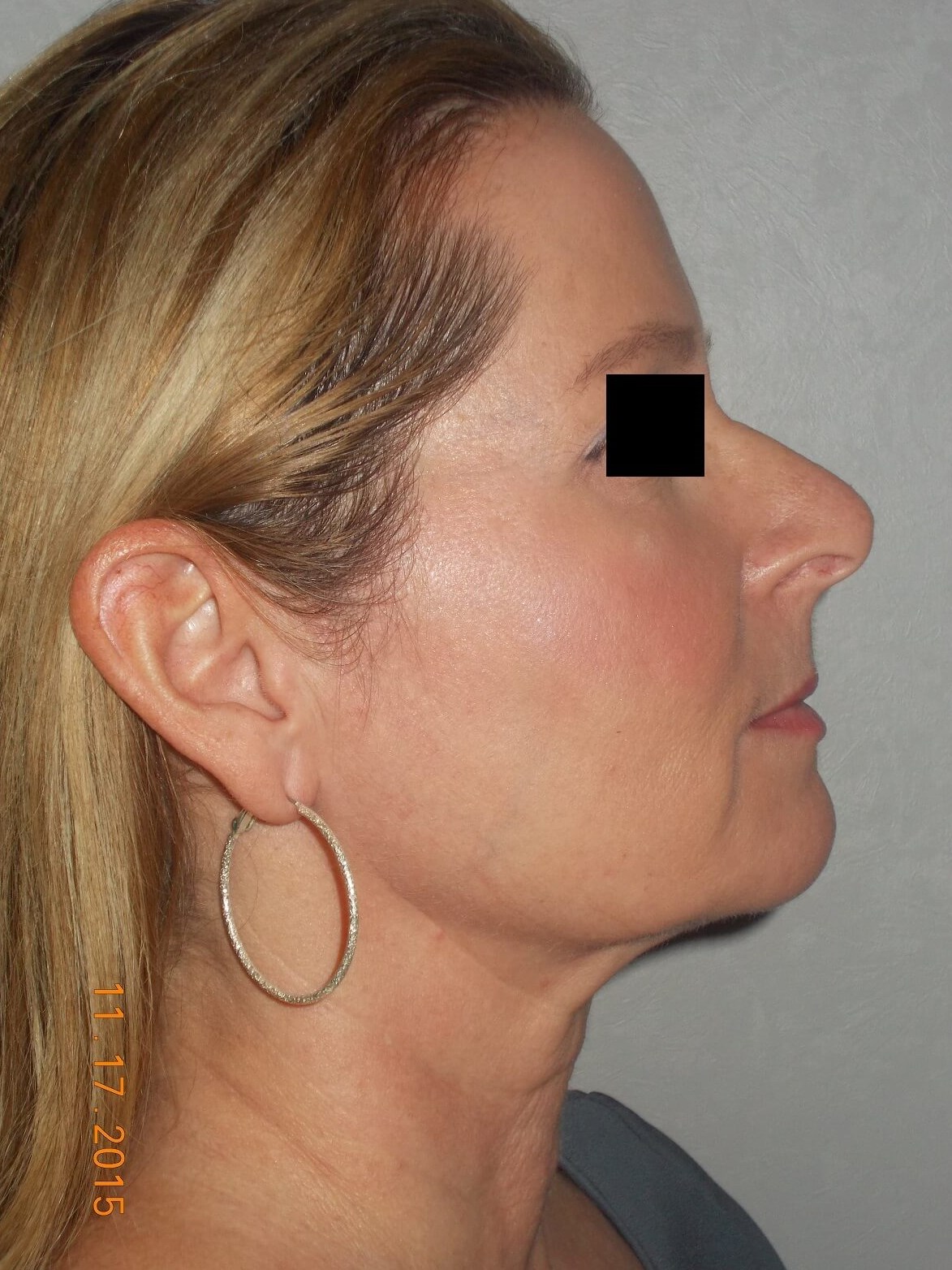 Side View Before