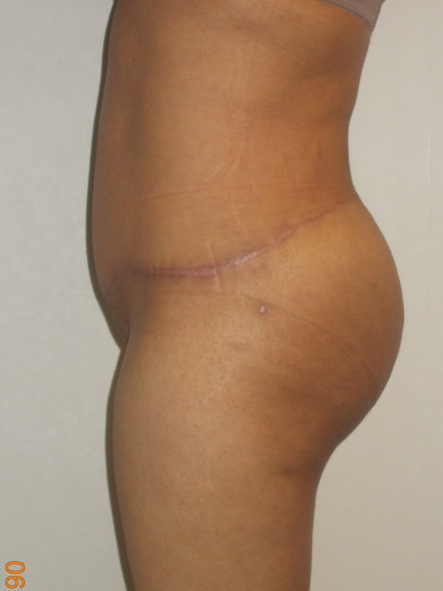 Side View After