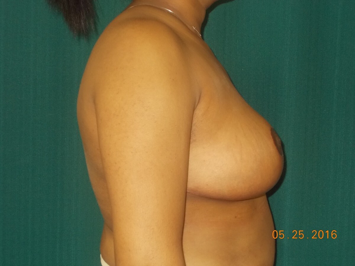 Side View After