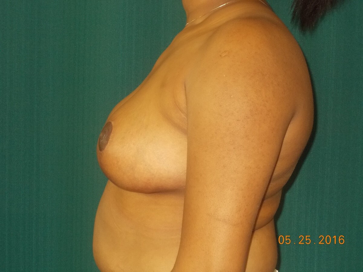 Side View After