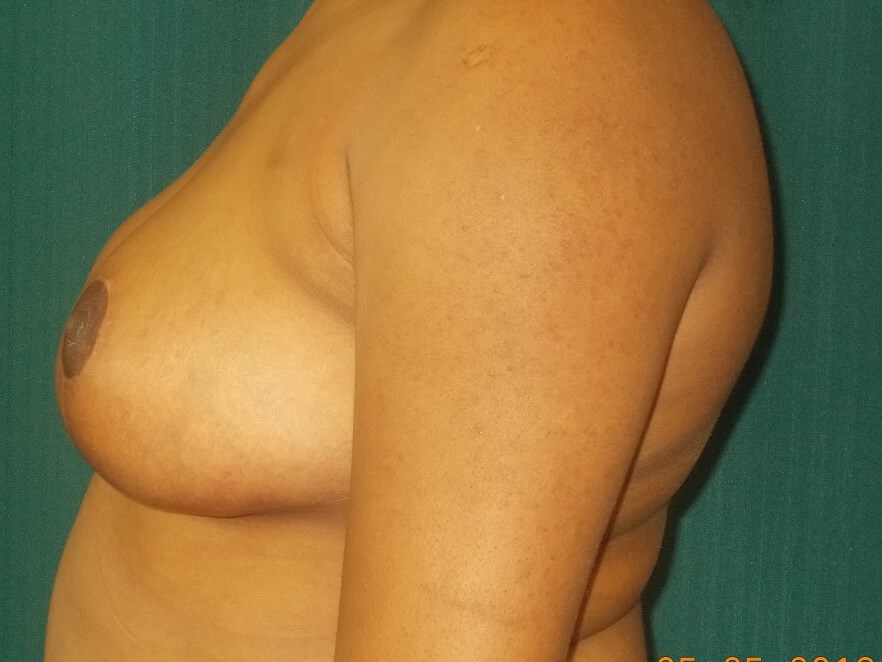 Side View After