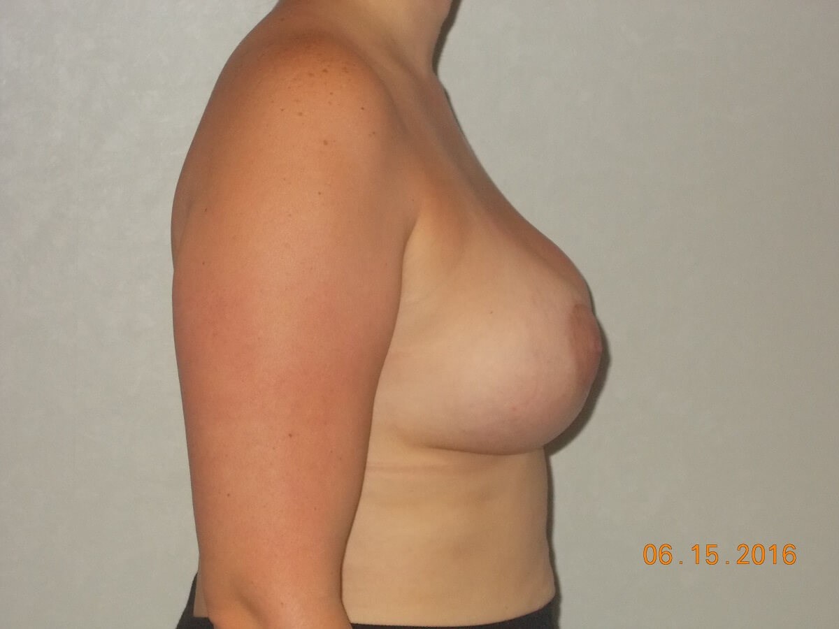 Side View After
