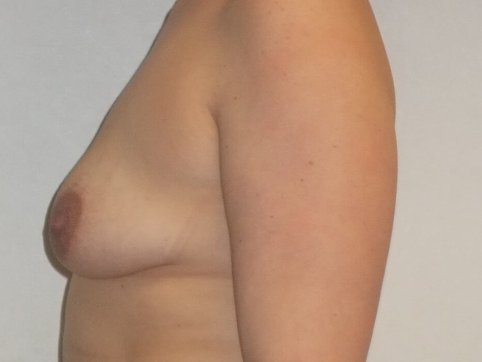 Side View Before
