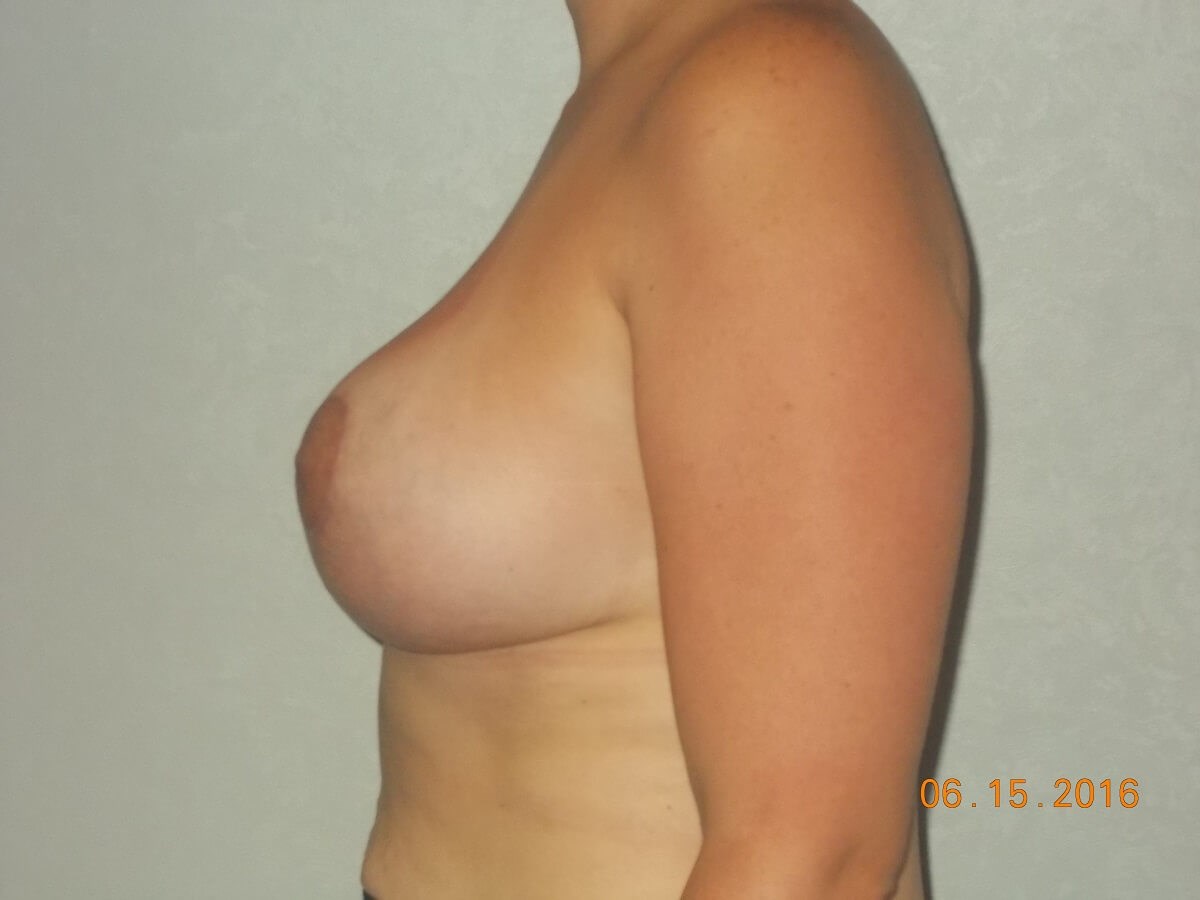 Side View After