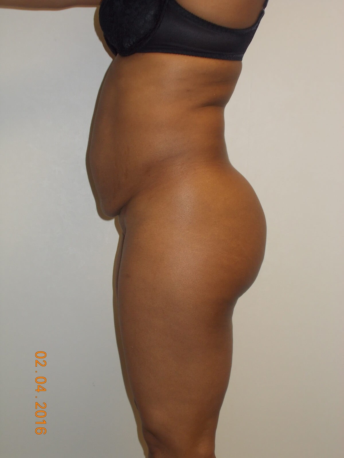 Side View Before