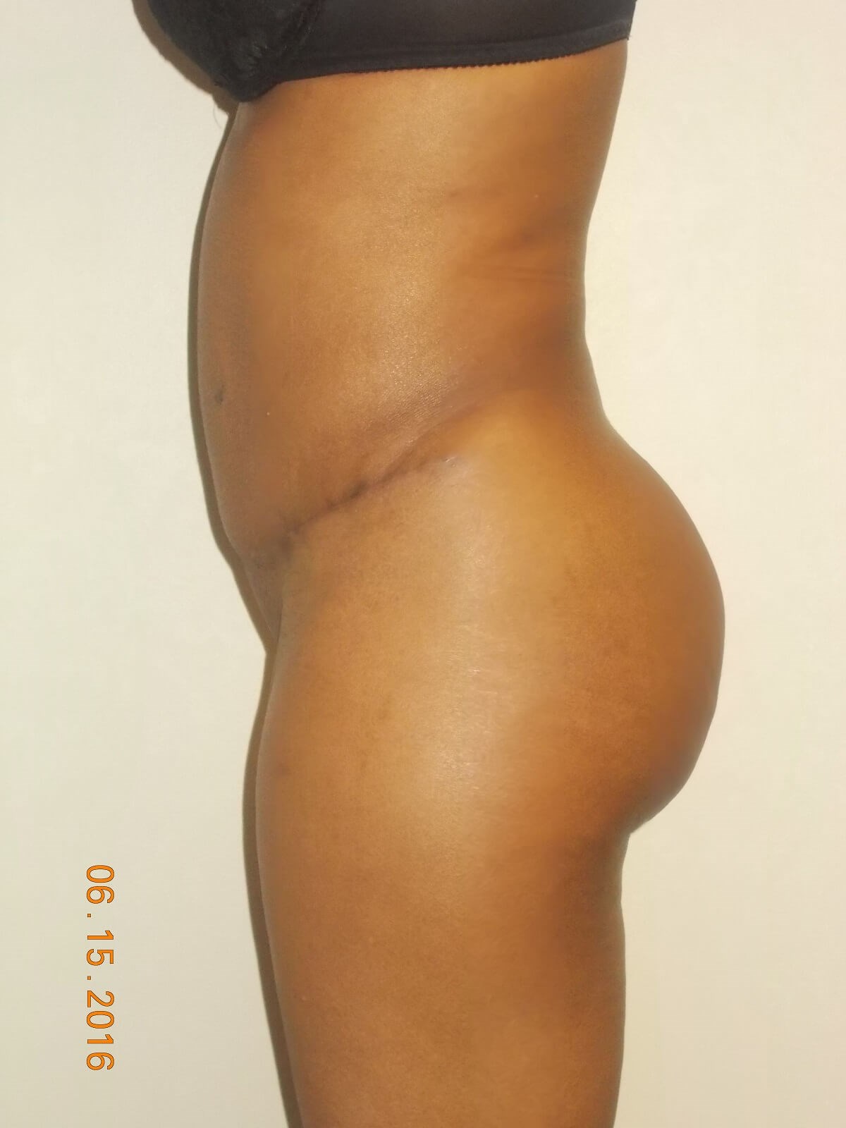 Side View After