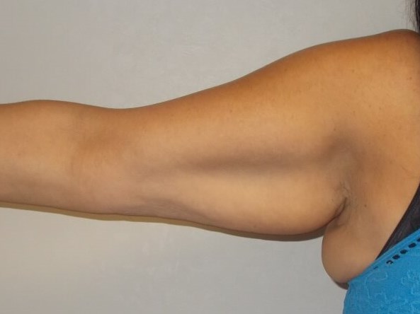 Front View Right Arm Before