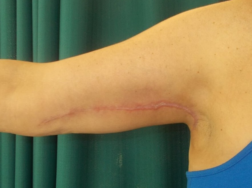 Front View Right Arm After