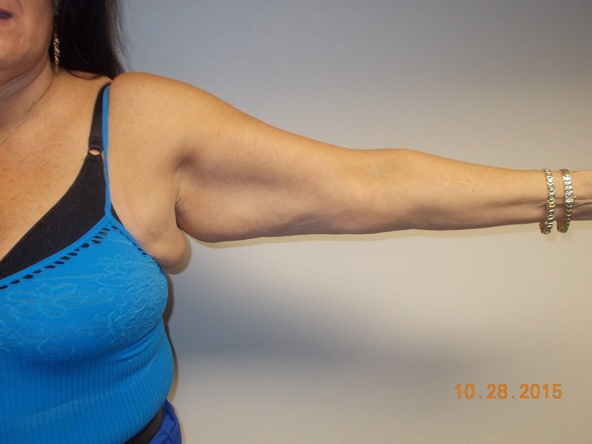 Front View Left Arm Before