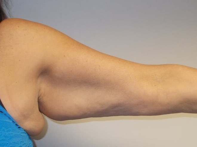 Front View Left Arm Before