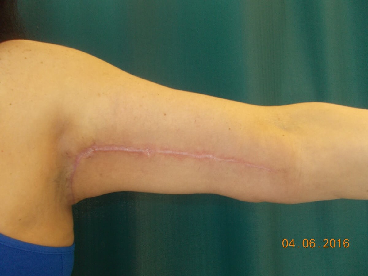 Front View Left Arm After