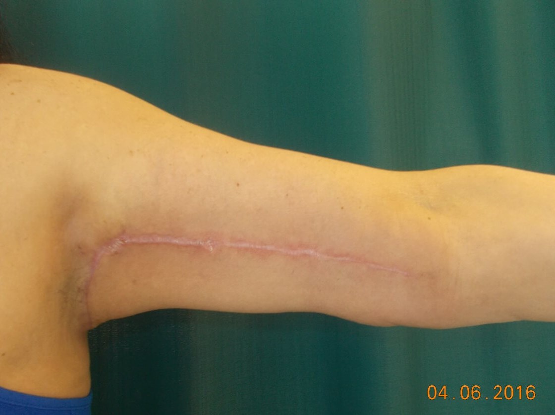 Front View Left Arm After