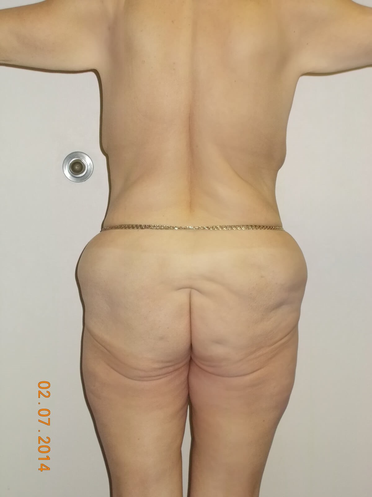 Back Side Before