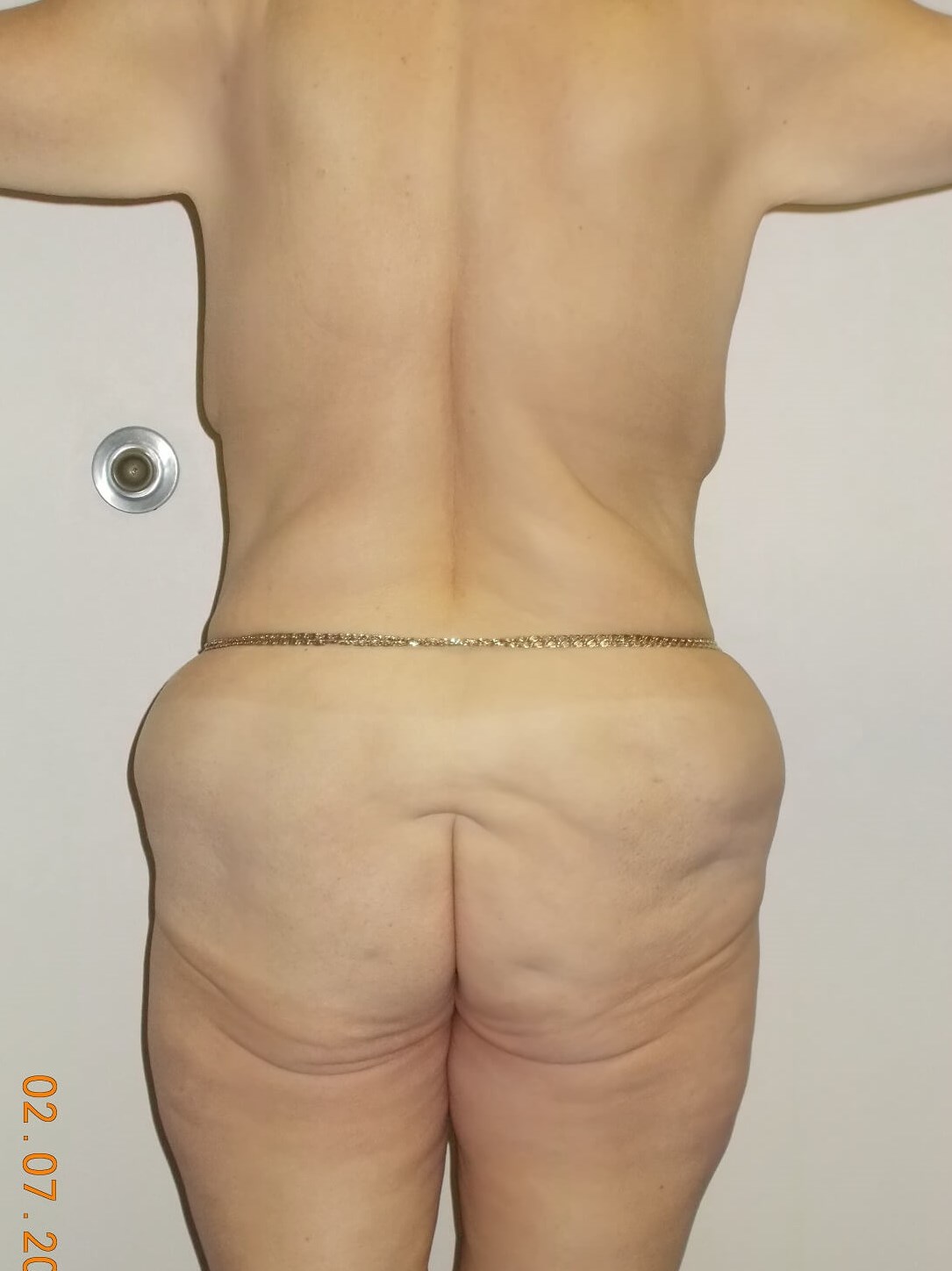 Back Side Before