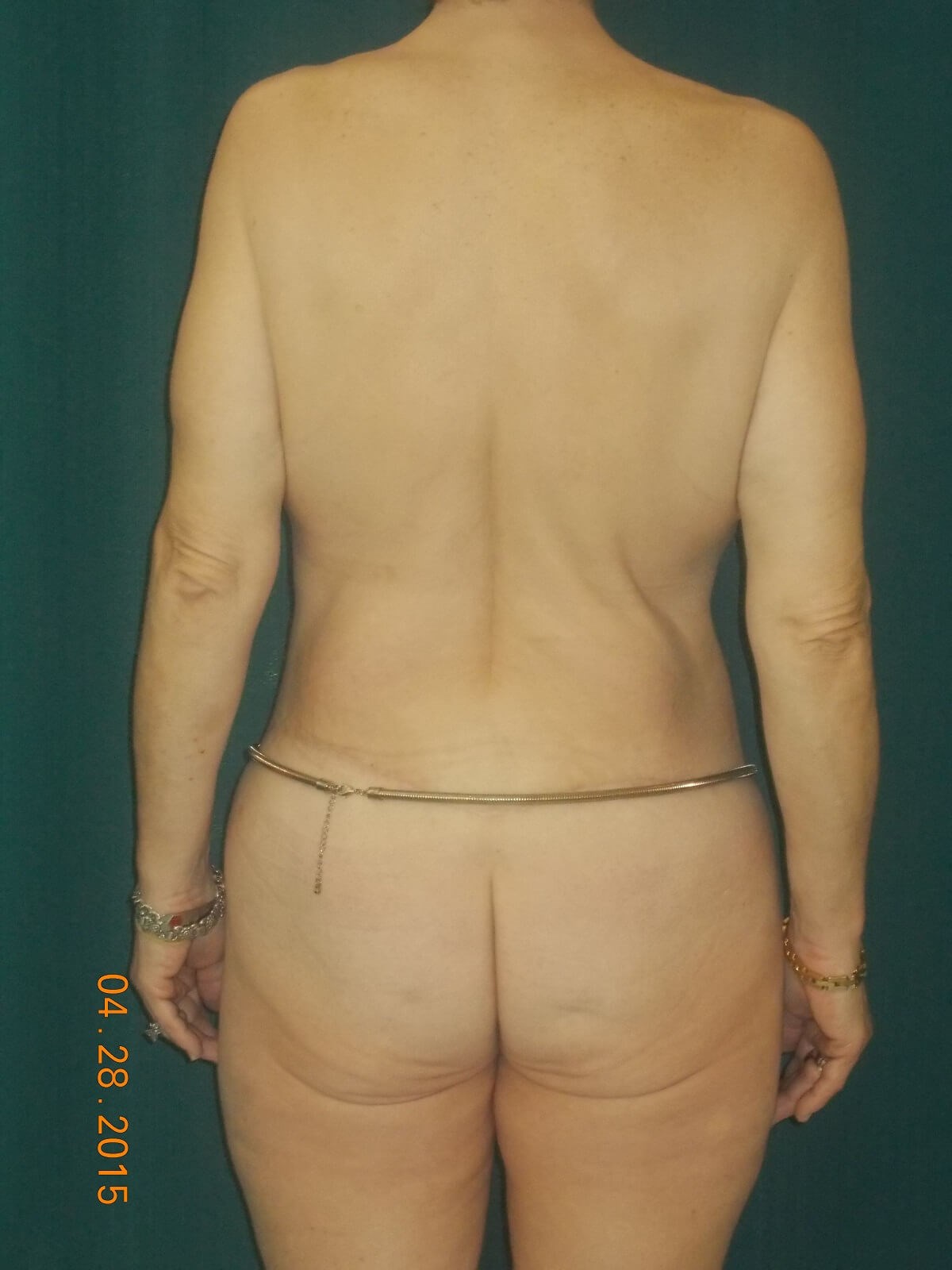 Back Side After