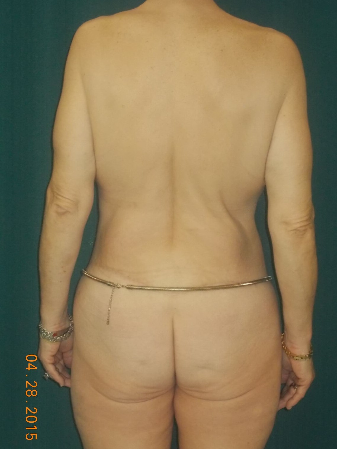 Back Side After