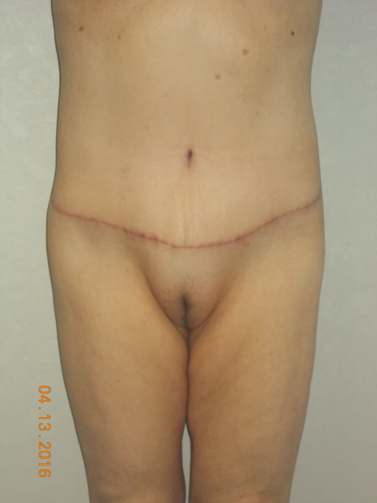 Front View After