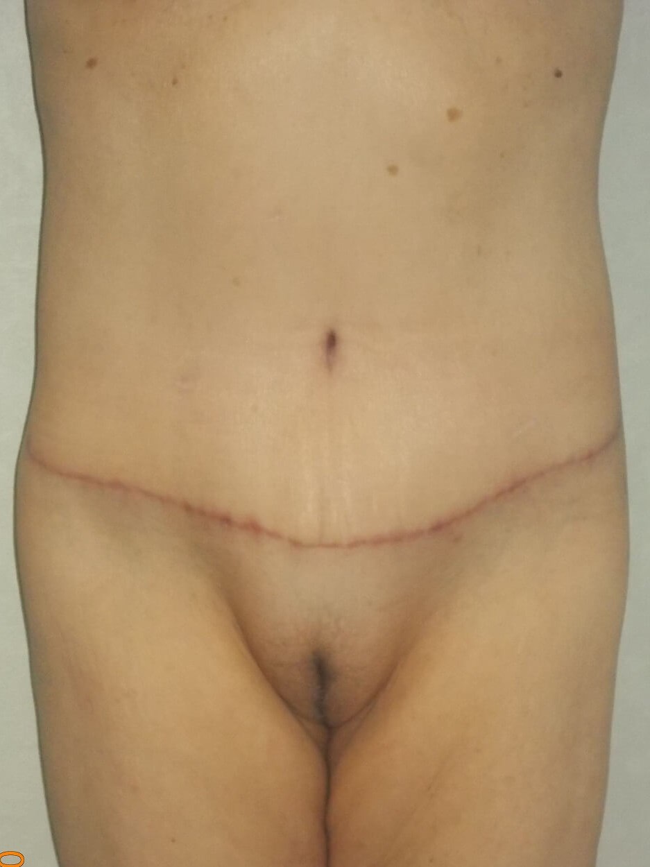 Front View After