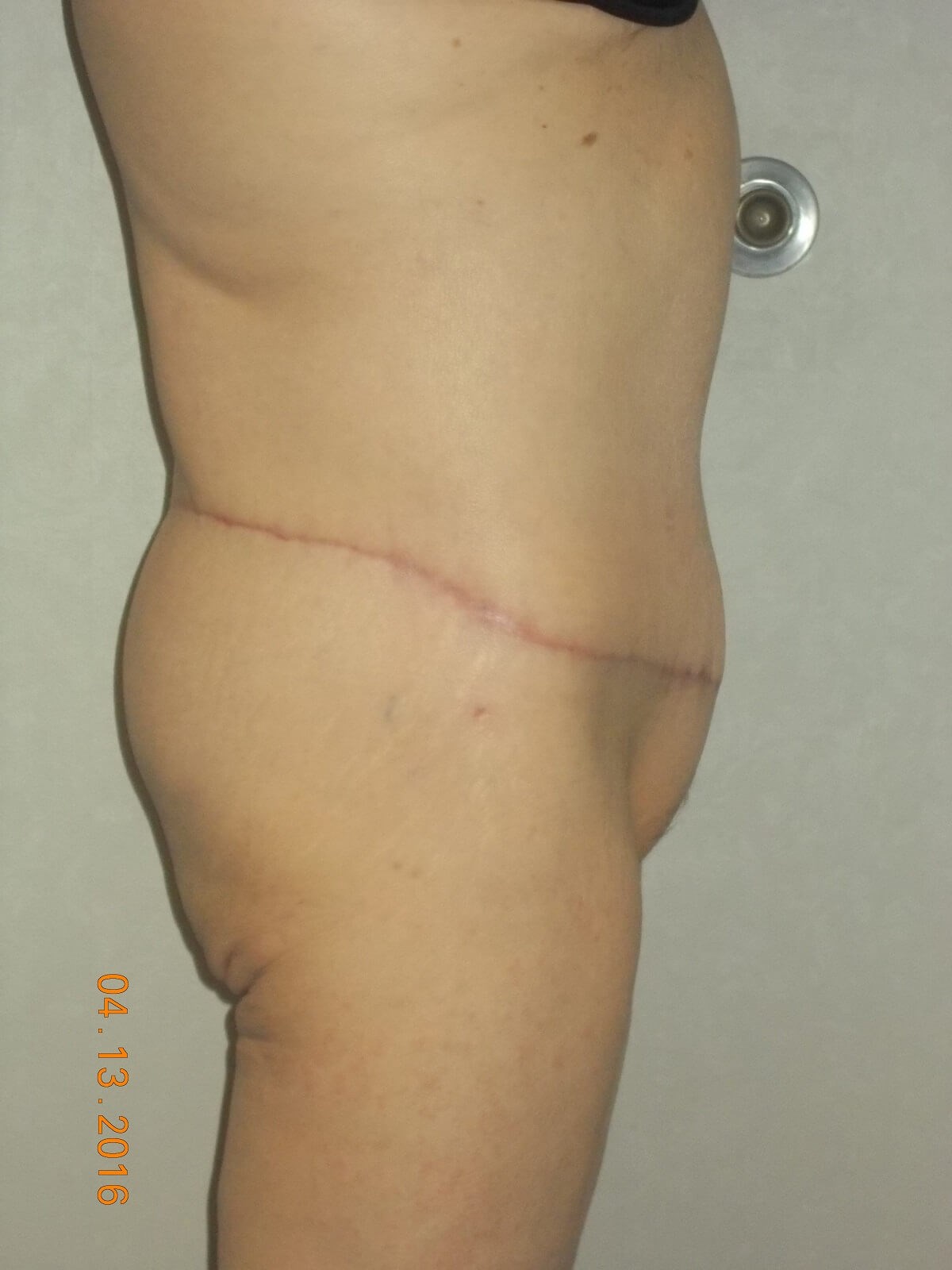 Side View After
