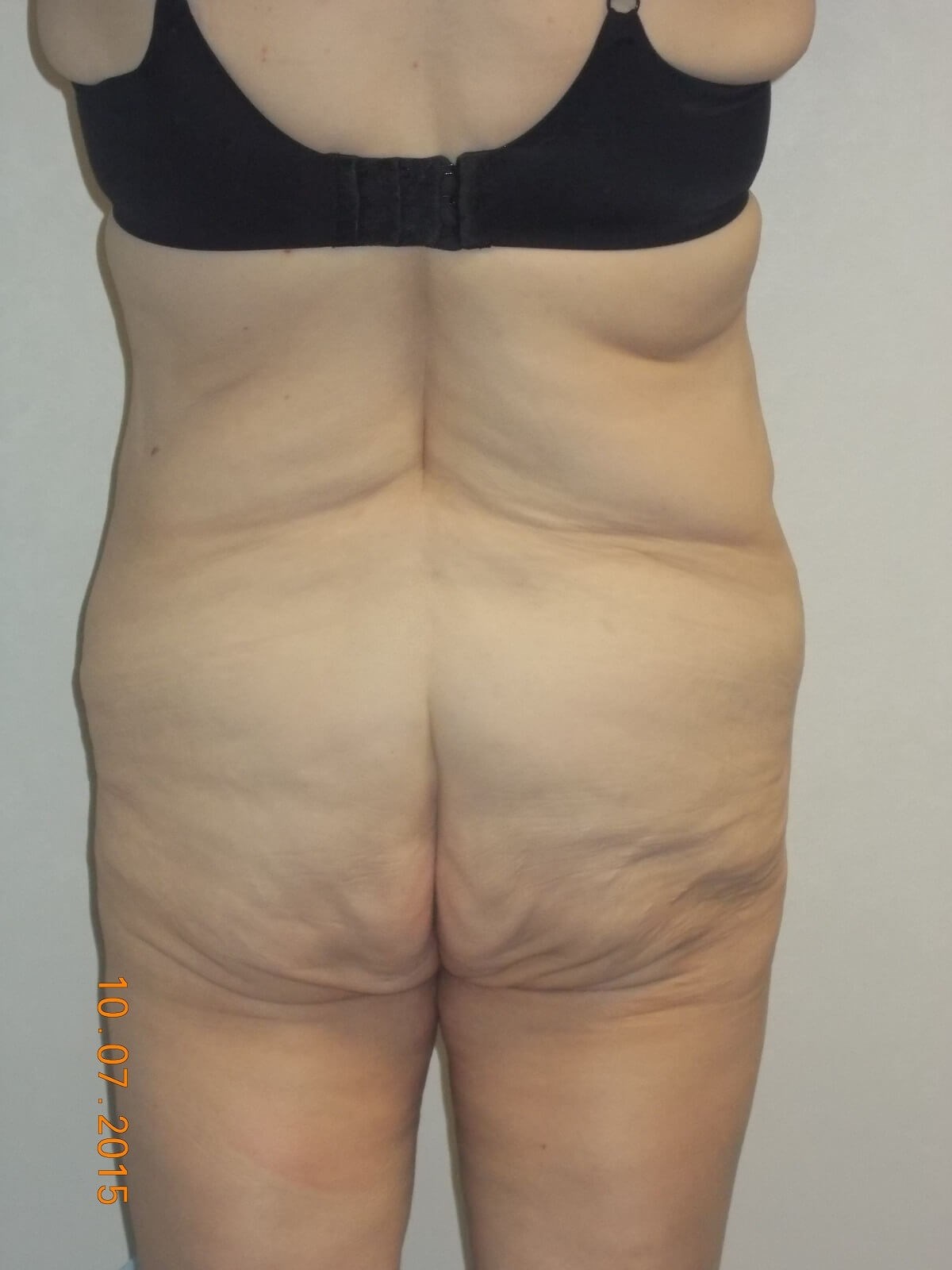 Back View Before