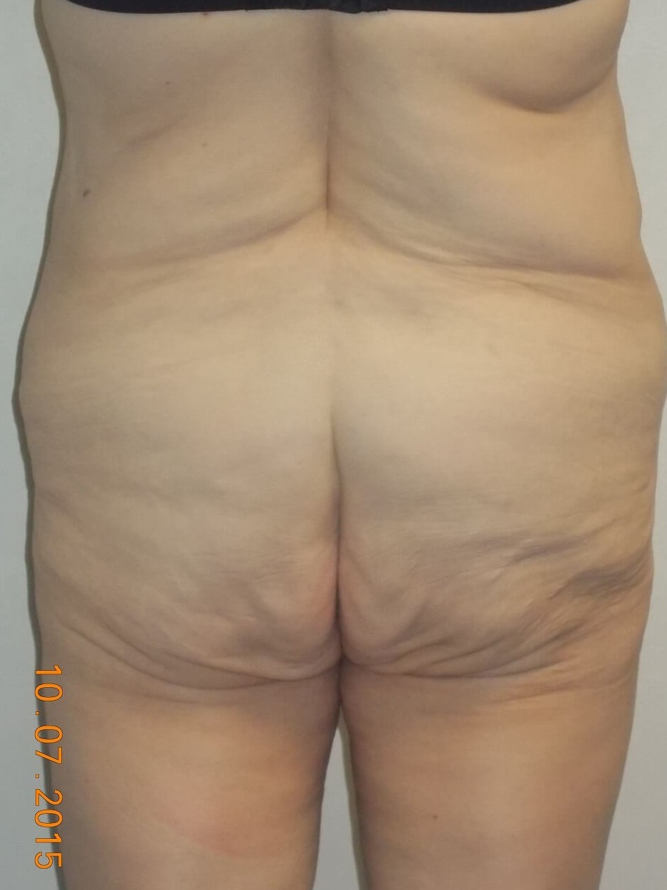 Back View Before