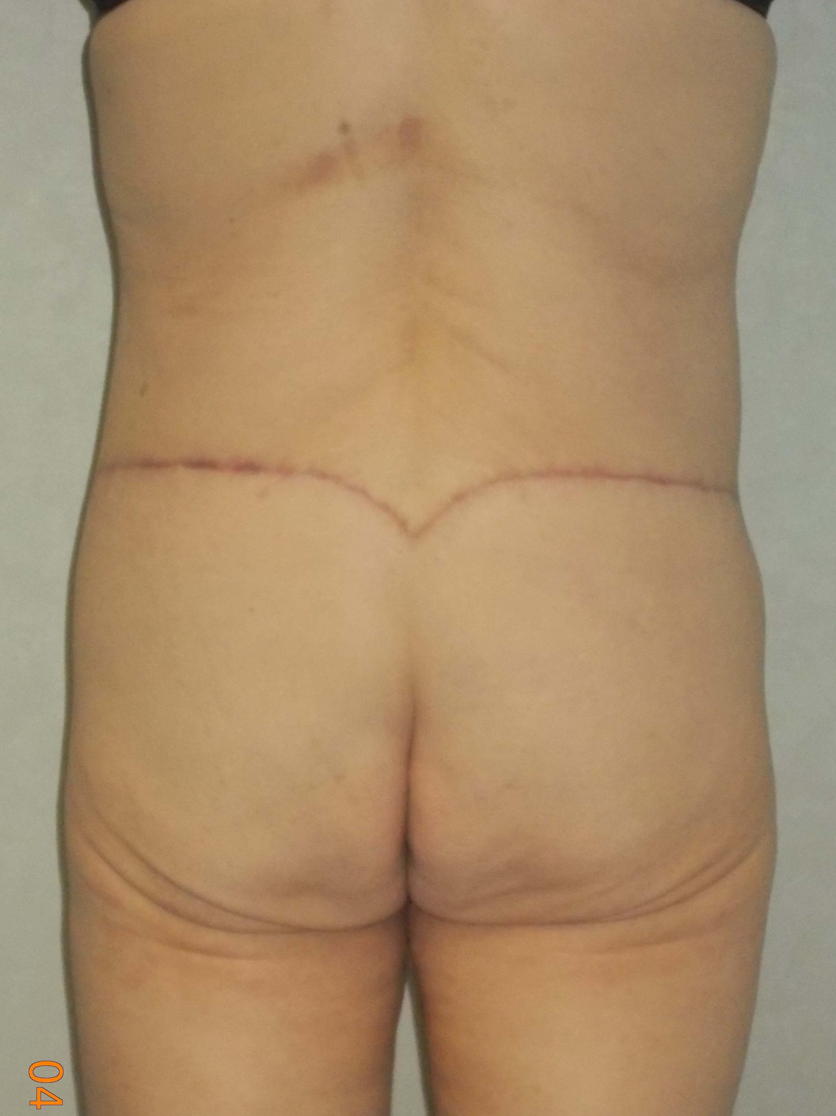 Back View After