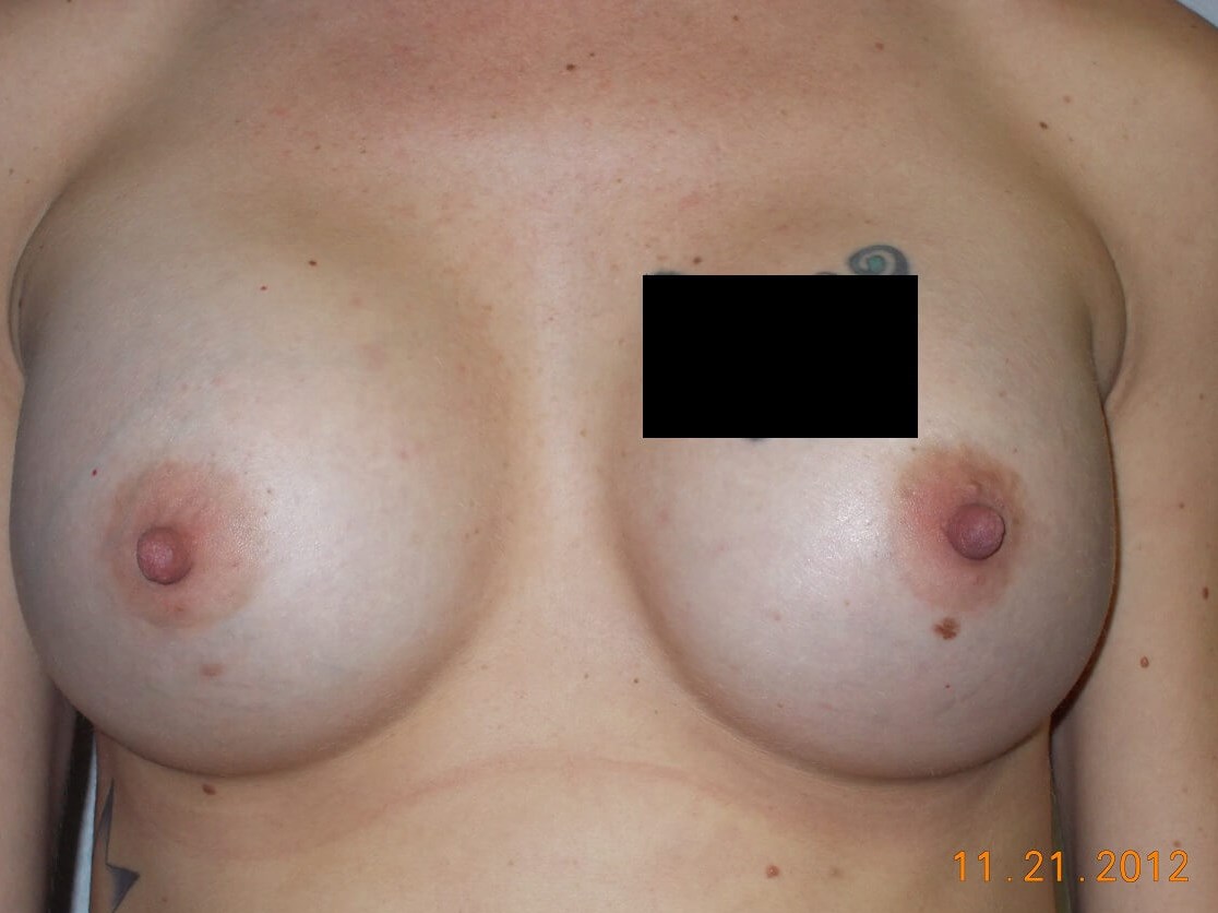 Front View After