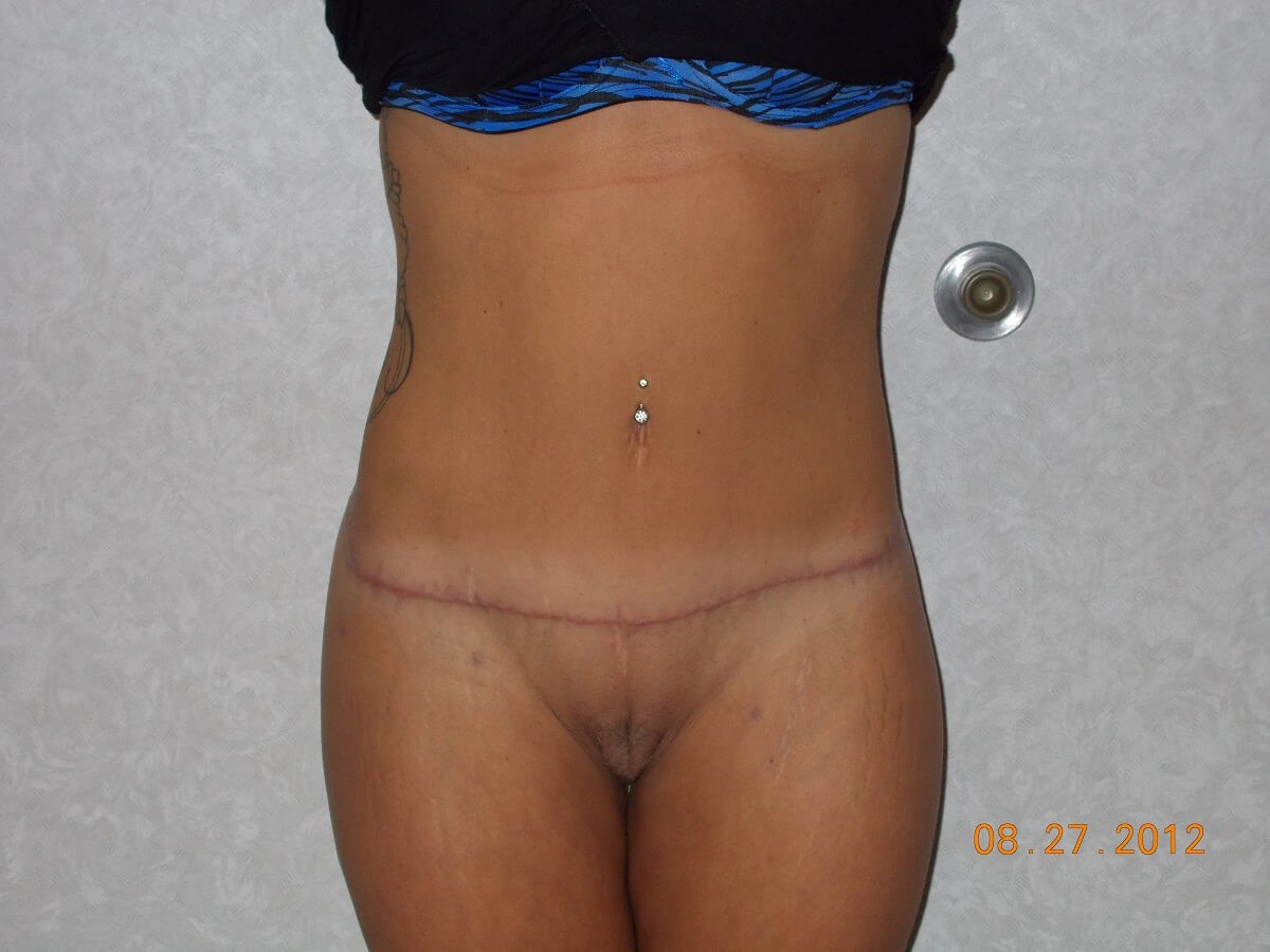 Front View After