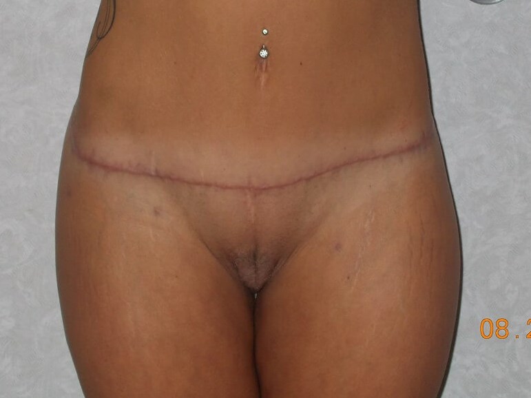 Front View After