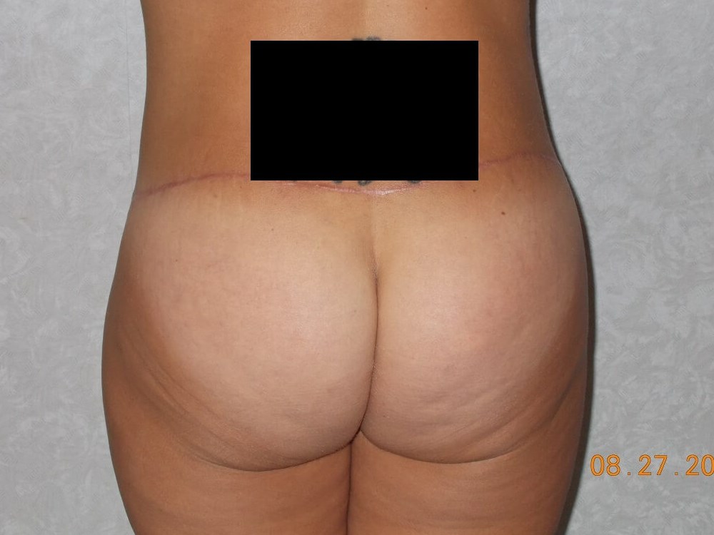 Back View After