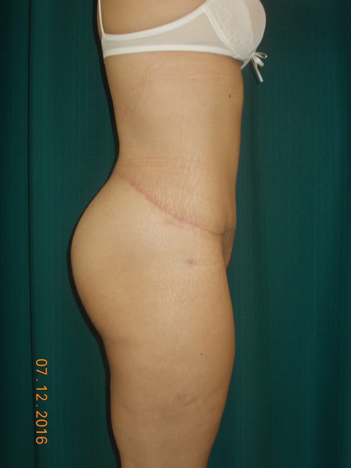 Side View After