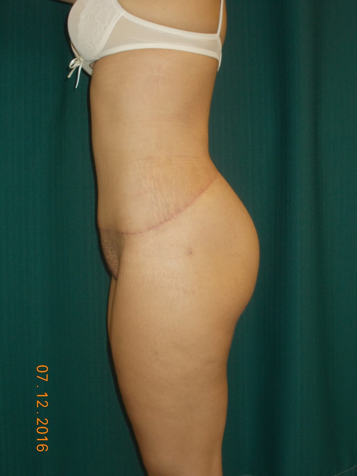 Side View After