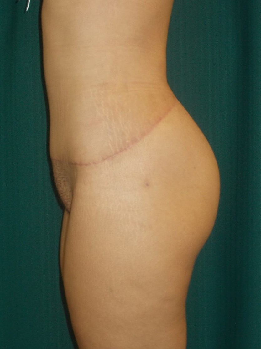 Side View After