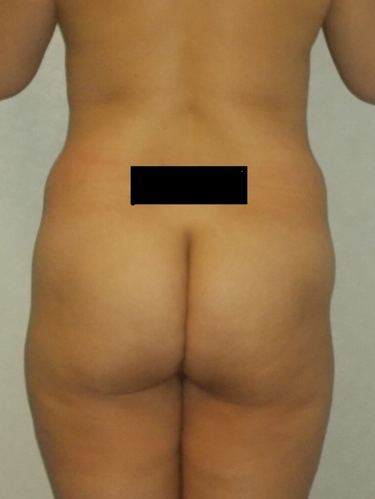 Back View Before